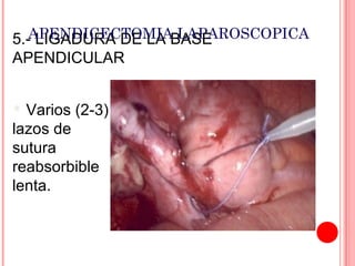 5.-APENDICECTOMIABASE
LIGADURA DE LA LAPAROSCOPICA
APENDICULAR
Varios (2-3)
lazos de
sutura
reabsorbible
lenta.


 