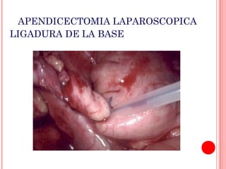 APENDICECTOMIA LAPAROSCOPICA
LIGADURA DE LA BASE

 
