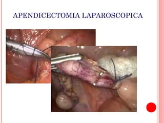 APENDICECTOMIA LAPAROSCOPICA

 