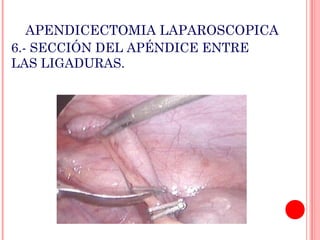 APENDICECTOMIA LAPAROSCOPICA
6.- SECCIÓN DEL APÉNDICE ENTRE
LAS LIGADURAS.

 