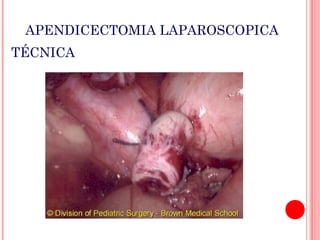 APENDICECTOMIA LAPAROSCOPICA
TÉCNICA

 