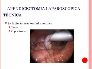 APENDICECTOMIA LAPAROSCOPICA
TÉCNICA


7.- Exteriorización del apéndice
 Bolsa
O

por trocar

 