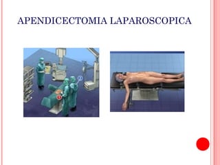 APENDICECTOMIA LAPAROSCOPICA

 