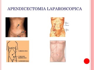 APENDICECTOMIA LAPAROSCOPICA

 
