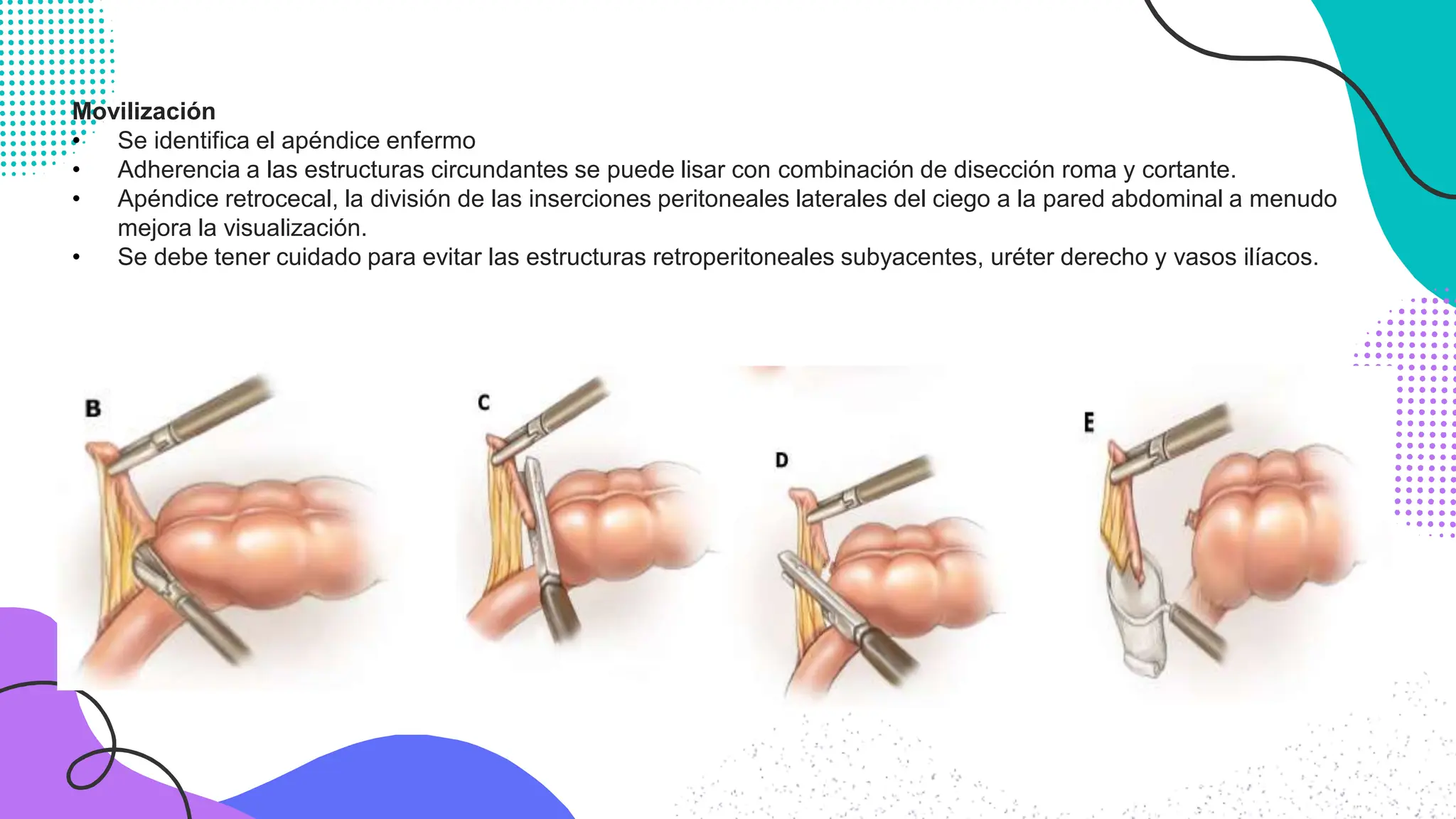 Apendicectomia laparoscopica TECNICAS.pptx