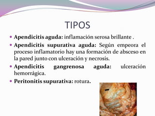 TIPOS
 Apendicitis aguda: inflamación serosa brillante .
 Apendicitis supurativa aguda: Según empeora el
proceso inflamatorio hay una formación de absceso en
la pared junto con ulceración y necrosis.
 Apendicitis gangrenosa aguda: ulceración
hemorrágica.
 Peritonitis supurativa: rotura.
 