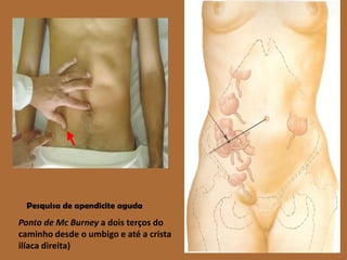 Ponto de Mc Burneya dois terços do caminho desde o umbigo e até a crista ilíaca direita)Pesquisa de apendicite aguda 