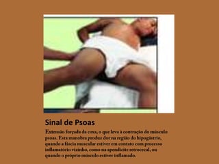 Sinal de PsoasExtensão forçada da coxa, o que leva à contração do músculo psoas. Esta manobra produz dor na região do hipogástrio, quando a fáscia muscular estiver em contato com processo inflamatório vizinho, como na apendicite retrocecal, ou quando o próprio músculo estiver inflamado. 