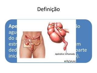 Definição
Apendicite aguda é a inflamação
aguda
do apêndice vermiforme, uma
estrutura que se assemelha a um
dedo de luva e se encontra na parte
inicial do intestino grosso (ceco).

 
