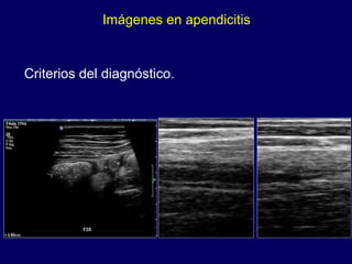 Imágenes en apendicitis Criterios del diagnóstico. 