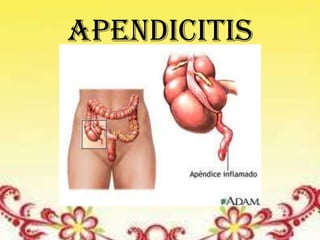 Apendicitis
 