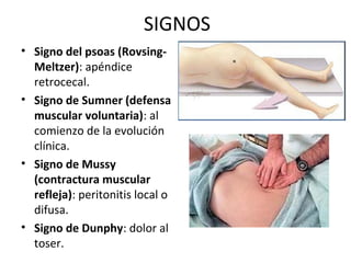 Apendicitis | PPT