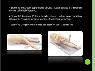 Apendicitis | PPTX