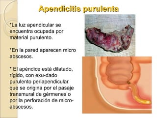 Apendicitis purulenta
*La luz apendicular se
encuentra ocupada por
material purulento.
*En la pared aparecen micro
abscesos.
* El apéndice está dilatado,
rígido, con exu-dado
purulento periapendicular
que se origina por el pasaje
transmural de gérmenes o
por la perforación de microabscesos.

 