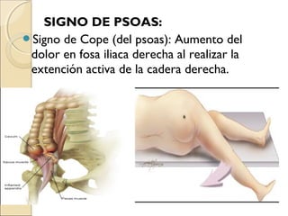 SIGNO DE PSOAS:
Signo de Cope (del psoas): Aumento del
dolor en fosa iliaca derecha al realizar la
extención activa de la cadera derecha.

 