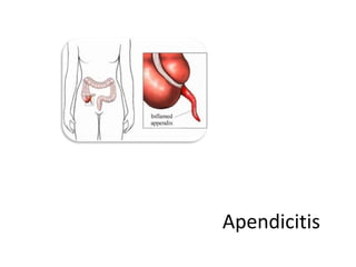 Apendicitis

 