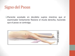 Signo del Psoas
Paciente acostado en decúbito supino mientras que el
examinador lentamente flexione el muslo derecho, haciendo
que el psoas se contraiga.

 