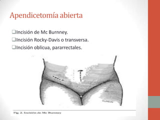 Apendicetomía abierta
Incisión de Mc Burnney.
Incisión Rocky-Davis o transversa.
Incisión oblicua, pararrectales.

 