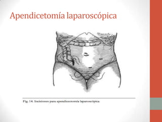Apendicetomía laparoscópica

 