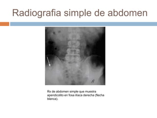 Radiografia simple de abdomen 
Rx de abdomen simple que muestra 
apendicolito en fosa ilíaca derecha (flecha 
blanca). 
 