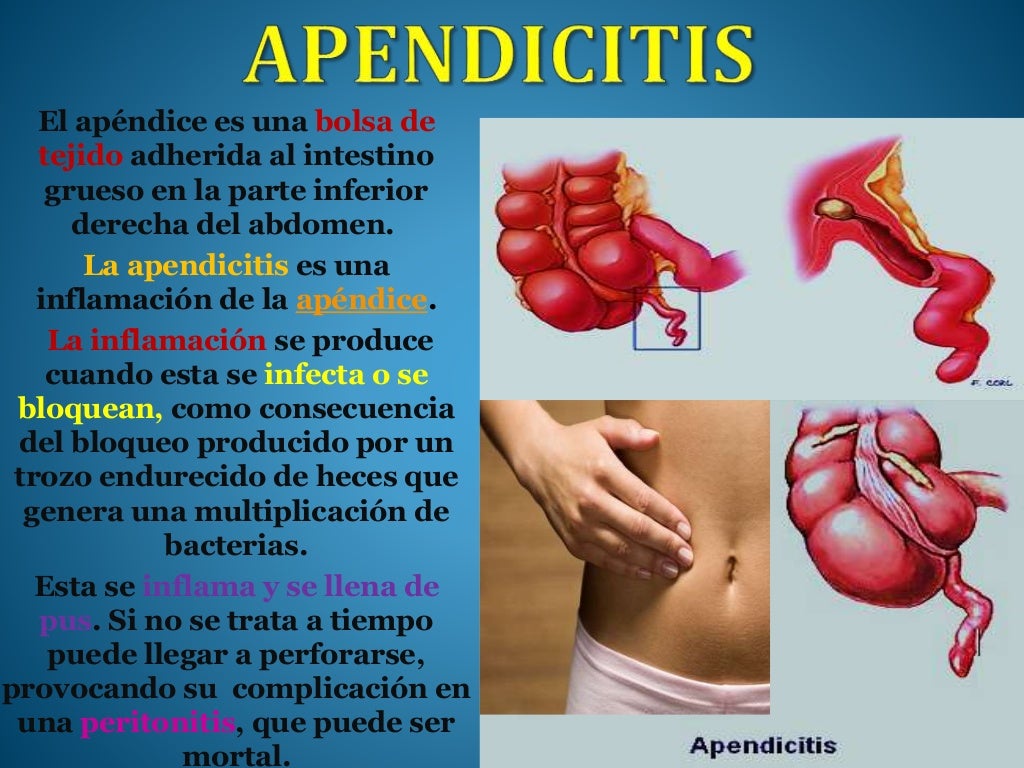 Apendicitis