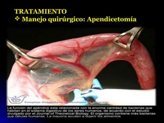TRATAMIENTO
 Manejo quirúrgico: Apendicetomía
 