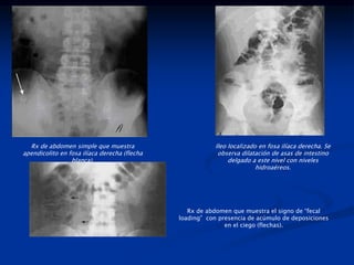 Rx de abdomen simple que muestra
apendicolito en fosa ilíaca derecha (flecha
blanca).
Ileo localizado en fosa ilíaca derecha. Se
observa dilatación de asas de intestino
delgado a este nivel con niveles
hidroaéreos.
Rx de abdomen que muestra el signo de “fecal
loading” con presencia de acúmulo de deposiciones
en el ciego (flechas).
 