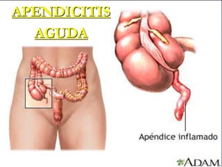 APENDICITIS
AGUDA
 