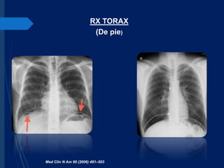 RX TORAX
(De pie)
Med Clin N Am 90 (2006) 481–503
 