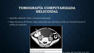 TOMOGRAFÍA COMPUTARIZADA
HELICOIDAL
• Apéndice dilatado >5cm y la pared engrosada
• Signo de punta de flecha: ciego engrosado que concentra medio de contraste hacia el
orificio de apéndice
Schwartz. Principios de cirugía. MC Graw Hill. 9 ed. 2011
 