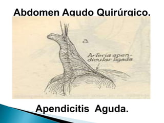 Abdomen Agudo Quirúrgico.
Apendicitis Aguda.
 