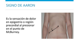 Apendicitis.pptx