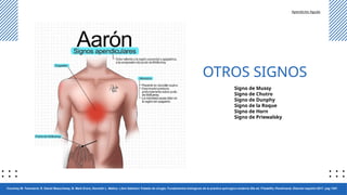 Apendicitis.pptx1236547891236547996212222 | PPTX