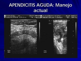 APENDICITIS AGUDA: Manejo
          actual
 