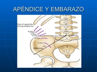 APÉNDICE Y EMBARAZO 