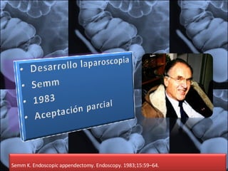 eSemm K. Endoscopic appendectomy. Endoscopy. 1983;15:59–64. 