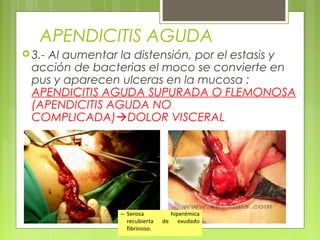 APENDICITIS AGUDA 
3.- Al aumentar la distensión, por el estasis y 
acción de bacterias el moco se convierte en 
pus y aparecen ulceras en la mucosa : 
APENDICITIS AGUDA SUPURADA O FLEMONOSA 
(APENDICITIS AGUDA NO 
COMPLICADA)DOLOR VISCERAL 
 