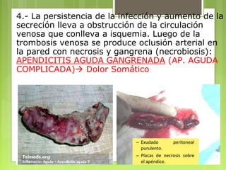 4.- La persistencia de la infección y aumento de la 
secreción lleva a obstrucción de la circulación 
venosa que conlleva a isquemia. Luego de la 
trombosis venosa se produce oclusión arterial en 
la pared con necrosis y gangrena (necrobiosis): 
APENDICITIS AGUDA GANGRENADA (AP. AGUDA 
COMPLICADA) Dolor Somático 
 