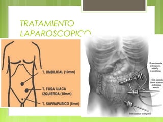 TRATAMIENTO 
LAPAROSCOPICO 
 