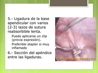  5.- Ligadura de la base 
apendicular con varios 
(2-3) lazos de sutura 
reabsorbible lenta. 
– Puede aplicarse un clip 
(previa expresión). 
– Preferible stapler si muy 
inflamado 
 6.- Sección del apéndice 
entre las ligaduras. 
 