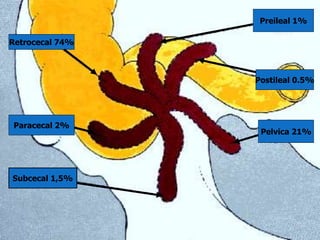 Apendicitis Cirugía Abdomen | PPTX