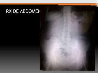 RX DE ABDOMEN

 