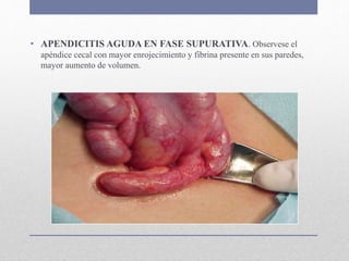 • APENDICITIS AGUDA EN FASE SUPURATIVA. Observese el
apéndice cecal con mayor enrojecimiento y fibrina presente en sus paredes,
mayor aumento de volumen.
 