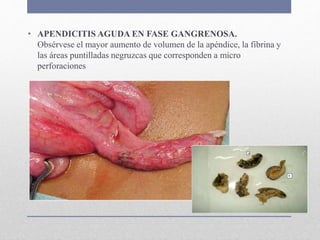 • APENDICITIS AGUDA EN FASE GANGRENOSA.
Obsérvese el mayor aumento de volumen de la apéndice, la fibrina y
las áreas puntilladas negruzcas que corresponden a micro
perforaciones
 