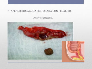 • APENDICITIS AGUDA PERFORADA CON FECALITO.
Obsérvese el fecalito.
 