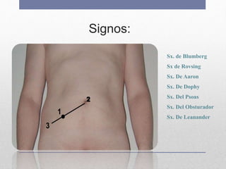 Signos:
Triada Murphy:
1. Dolor Abd.
2. Nauseas/Vomito
3. Febricula
Triada Dielafoy:
1. Hiperestesia Cutánea FID
2. Reflejo Muscular FID
3. Dolor Provocado FID
Sx. de Blumberg
Sx de Rovsing
Sx. De Aaron
Sx. De Dophy
Sx. Del Psoas
Sx. Del Obsturador
Sx. De Leanander
 