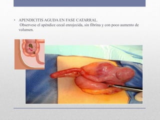 • APENDICITIS AGUDA EN FASE CATARRAL.
Observese el apéndice cecal enrojecida, sin fibrina y con poco aumento de
volumen.
 