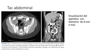 Apendicitis 1 pptx Apendicitis 1 pptx