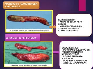 APENDICITIS GANGRENOSA
o NECROTICA
CARACTERISTICA:
• AREAS DE COLOR ROJO
OSCURO
• MICROPERFORACIONES
• LIQUIDO PURULENTO
• OLOR FECALOIDEO
APENDICITIS PERFORADA
CARACTERISTICA:
• PERFORACION , LA CUAL ES
FRECUENTE EN BORDE
ANTIMESENTERICO
• LIQUIDO PERITONEAL
PURULENTO
• PLASTRON APENDICULAR
• ABSCESO APENDICULAR
 