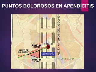 PUNTOS DOLOROSOS EN APENDICITIS
 